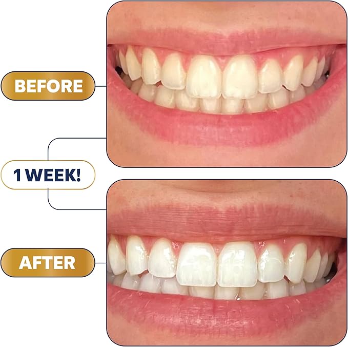 Lumineux Teeth Whitening Strips Kit - Image 3